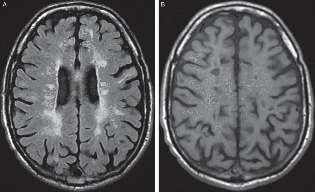 mri brain