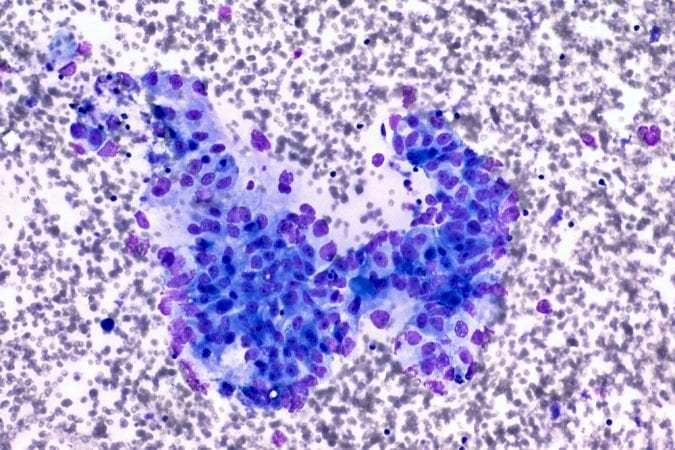 Micrograph of pancreatic cancer cells