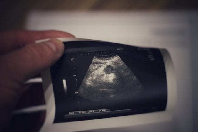 Ultrasound Image Showing Pancreatiic Cancer